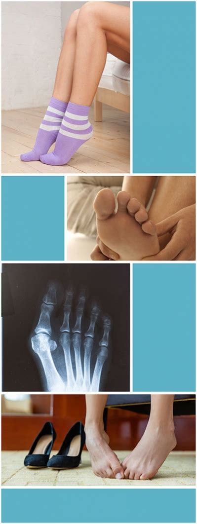 Es gibt verschiedene methoden, einen hallux valgus zu operieren. Die Symptome und Folgen von Hallux Valgus | ORTHO - Praxis ...