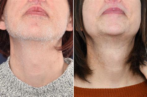 Result after 38 hours of electrolysis before and after FFS - 2pass Clinic