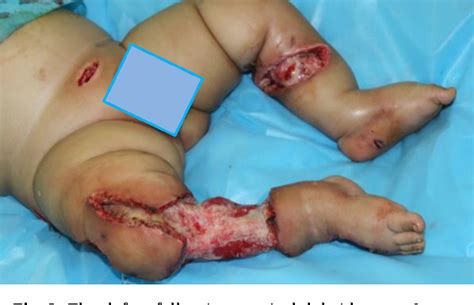 Necrotizing fasciitis has also been referred to as hemolytic streptococcal gangrene, meleney ulcer, acute dermal gangrene, hospital gangrene, suppurative fasciitis, and synergistic necrotizing cellulitis. Figure 2 from Severe Multiple Necrotizing Fasciitis ...