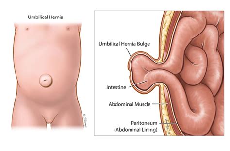 Urutan atau rawatan tradisional tidak akan membantu menyembuhkan penyakit ini. 'Angin Pasang' (Hernia) Pada Bayi Tak Boleh Diurut ...