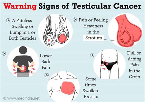The most common place for testicular cancer to spread to is nearby lymph nodes in your tummy (abdomen) or lungs. Testicular Cancer - Symptoms and Signs