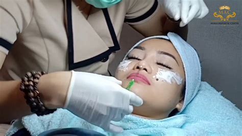 Translate the description into english (united states) using google translate?translate the description back to indonesian. FENOMENA BIKIN HIDUNG MANCUNG! TANAM BENANG AJA. - YouTube