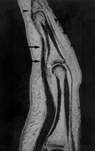 To check fds function, hold all adjacent fingers in extension and then release the finger you want to assess. MR Imaging of Ligament and Tendon Injuries of the Fingers ...