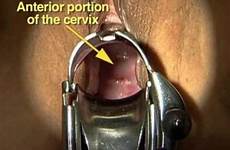 speculum examination pelvic