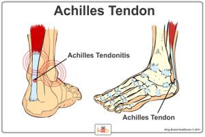 Some of these bones can move freely. Achilles Tendonitis Services Quakertown, PA -Foot & Ankle Doctor | Sports Podiatrist Quakertown