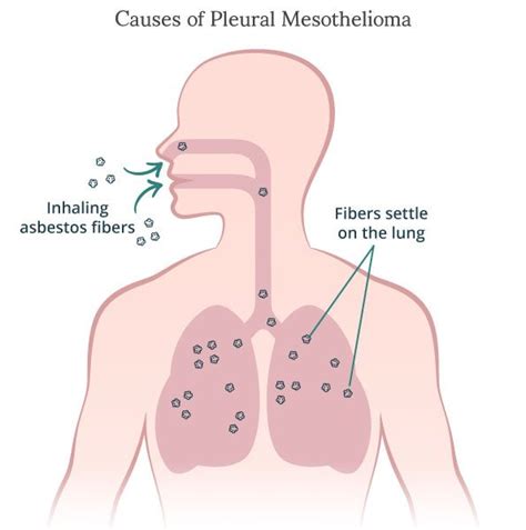 The asbestos fibers lodge in the lining of the lungs, abdomen or heart. Mesothelioma Causes: Dangers of Asbestos & Other Risks