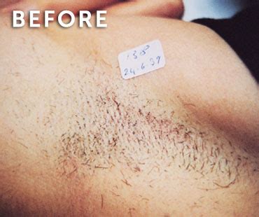 Laser hair removal is a popular solution to removing unwanted hair. Laser Hair Removal in New Jersey | SOMA Skin & Laser