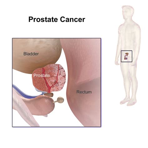 When cancer grows large enough to press on nearby organs or nerves, it causes some distinctive symptoms. Common Symptoms of Prostate Cancer - Be Aware of Them