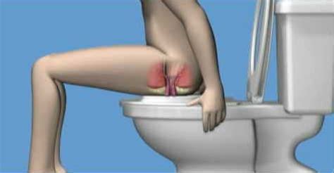 Hämorrhoiden sind erweiterungen der gefässpolster im analkanal, die zu blutungen, schmerzen und entzündungen führen. Hämorrhoiden - Bodfeld Apotheke