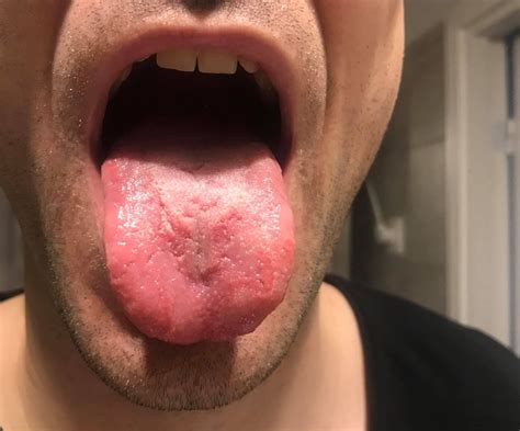 Geographic tongue since being with a girl | Oral and Dental Problems ...