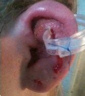 How do you treat an infected piercing? How to get rid of bubbles on my cartilage piercing - Quora