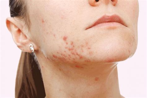 Nature has provided you with everything you need to fight the battle against acne. 26 Natural ways to treat cystic acne