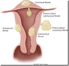 Siklus haid bisa menyebabkan fluktuasi hormon estrogen dan progesterone. SITUS REPRODUKSI 4 U: MENORAGIA