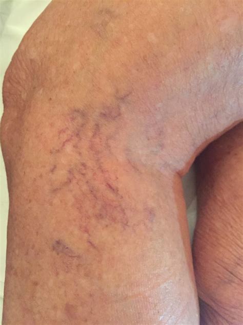 Terapia sclerosante per capillari - Studio Medico Santoro