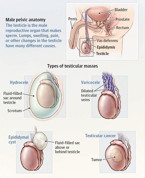 The most common testicular cancer symptom is a lump or a swelling in. Testicular Mass. JAMA. 2016;316(5):557. doi:10.1001/jama ...