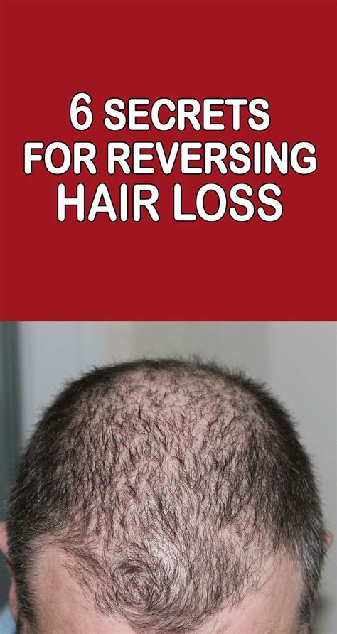 It's your genes you need to blame. Does Testosterone Cause Hair Loss | Uphairstyle