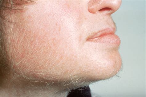 The hairs themselves get cleaned and moisturized, which makes any beard look more thick and lush. Hirsutism