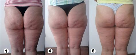 Lpg ist eine tiefenmassage, die das unterhautgewebe der problemzonen. Cellulite Die Wahrheit Über Die Orangenhaut - Trainsane ...