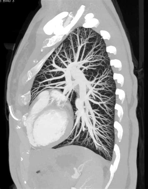 Check spelling or type a new query. MIP of the Lung Parenchyma - Chest Case Studies - CTisus ...