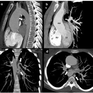 Pathophysiology, clinical features, and diagnosis of. Congenital causes of BAH-Tetralogy of Fallot and pulmonary ...