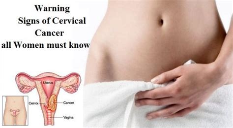 Early symptoms do not usually occur, but if they do, the most. Symptoms Of Cervical Cancer - Personal Health Record