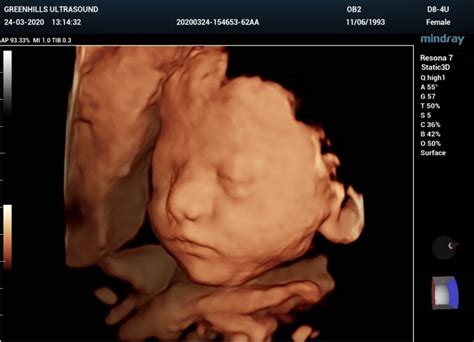An nt measurement can help your healthcare practitioner assess your baby's risk of having down syndrome and some other chromosomal abnormalities as well as major congenital heart problems. Ultrasound - GXU Medical Imaging