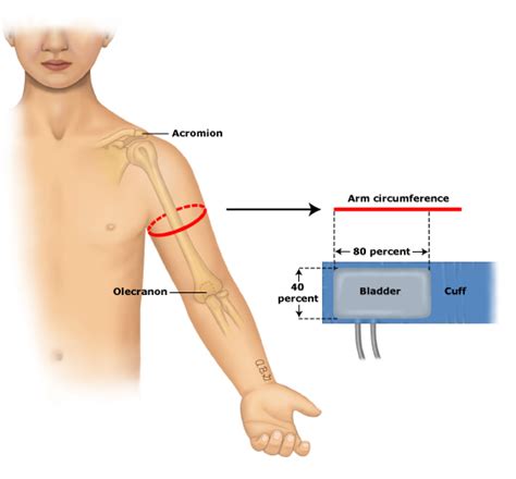 Bp measurement by auscultation is the gold standard. How to select correct cuff size for measuring blood pressure - Pediatric Practice… Pearls for ...