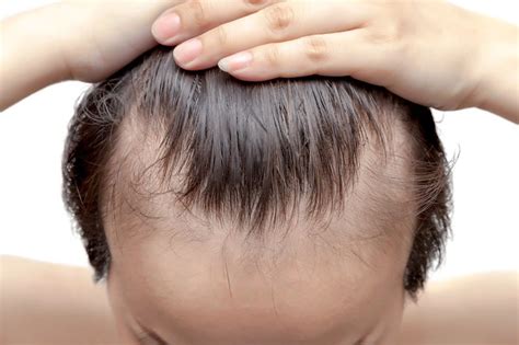 A wide variety of hair thinning hairline options are available to you, such as standard, processing service, and style. Tips for restoring your hairline