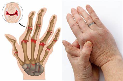Диета для жирных пальцев Ревматоидный Артрит Пальцев Рук Диета — Похудение Диета Правильное Питание Ревматоидный Артрит Пальцев Рук Диета — Похудение Диета Правильное Питание Диета для жирных пальцев