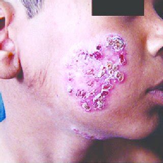 The journal is issued 12 times annually with content including articles by domestic and foreign authors. Well defined erythematous crusted plaque of lupus vulgaris ...
