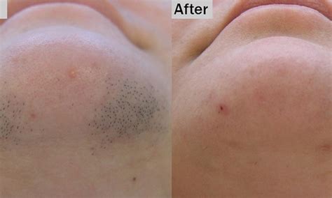 Get laser hair removal, but not just from anyone. Best Laser Hair Removal | Skincare Spa - Boston, MA