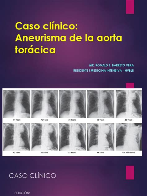 An abdominal aortic aneurysm is an enlarged area in the lower part of the major vessel that supplies blood to the body (aorta). Caso Aneurisma de Aorta Toracica | Aorta | Medicina