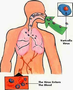 Penyakit pes disebabkan oleh bakteri yersinia pestisida yang ditularkan oleh tikus dan hewan pengerat lainnya. Chickenpox (Cacar Air) | Aura Ummi