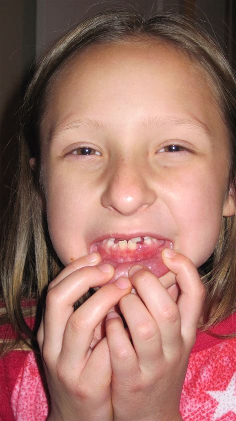 So how to fix loose tooth at home easily? The Nelson Family 2002: BrayLynn lost not just one but two ...