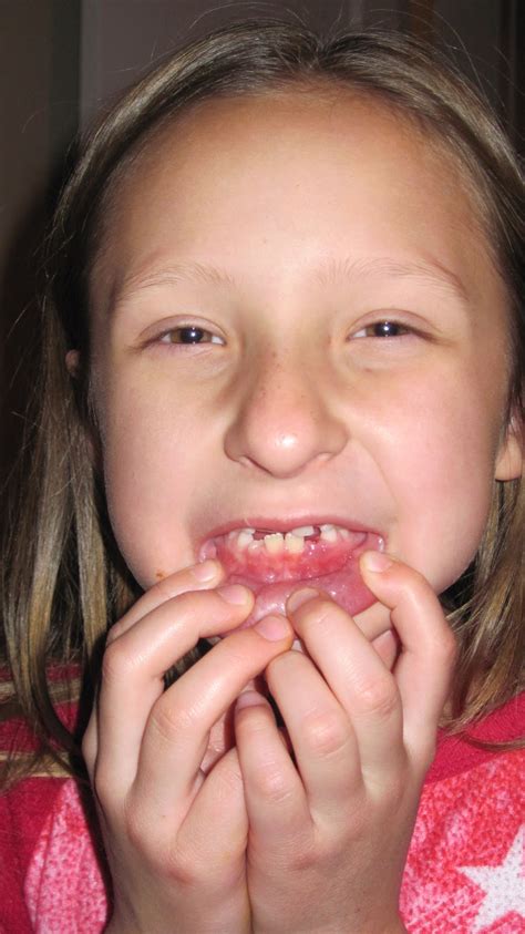 Here is how to strengthen loose teeth using these remedies. The Nelson Family 2002: BrayLynn lost not just one but two ...