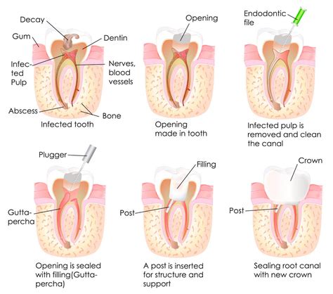 The procedure involves the removal of the damaged or infected tissue within the tooth, the cleaning and. Root Canal | AC Pediatric Dentistry & Orthodontics