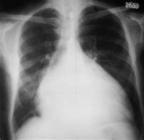 Aspects ecg de la péricardite, myocardite, épanchement péricardique. PERICARDITE ACUTE SI CRONICE - Cauze de afectare pericardica