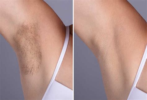 While all the home remedies mentioned above can give you impressive results over time, laser therapy can offer you instant removal of hair that is also absolutely permanent. how to remove underarm hair easy tricks and home remedies