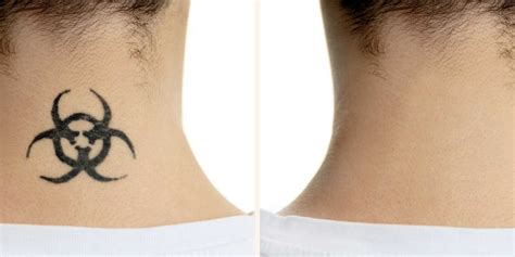 Locate and compare laser tattoo removal in scarborough on, yellow pages local listings. Aloe Vera Tattoo Removal Before And After - Best Tattoo Ideas