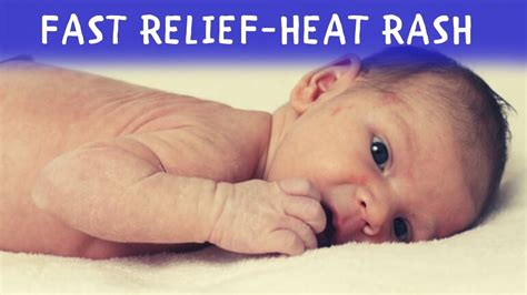 A focus on baby heat rash, on face of the baby, pictures, treatment, get rid of it, remedy and how long it can last. Home Treatment for Heat Rash in Babies | Fast Relief | Baby's Dream - YouTube