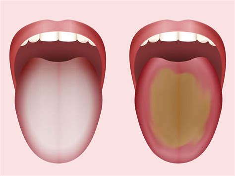 Bei darmkrebs treten anfangs meist unspezifische symptome auf, daher werden die anzeichen oft nicht richtig gedeutet. Belegte Zunge: Was bedeutet ein Zungenbelag? | Liebenswert ...