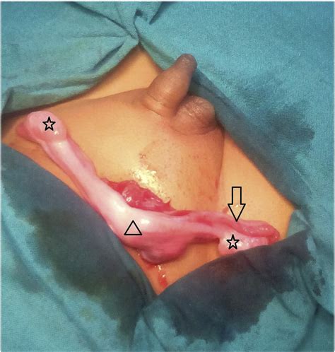 Of, pertaining to, or discovered by, johannes müller. References in Persistent mullerian duct syndrome: A 24 ...