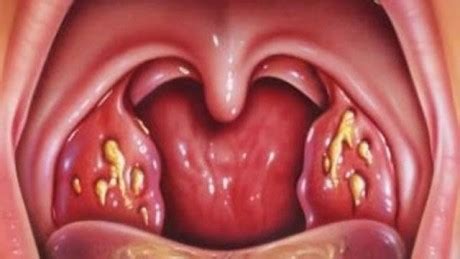 Select from premium tonsillitis of the highest quality. Tonsil Cancer - Causes, Symptoms, Treatment
