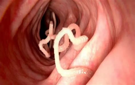 Ibu guru mengajar tentang bahaya miras dng contoh 2 ekor cacing, cacing yang 1 di masukan ke dalam air mineral & cacing yg ke 2 di masukan ke dalam miras. Ada Cacing Parasit 30cm dalam Perut - PinoQQ Lounge