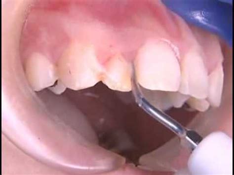 How much does a dental cleaning cost? How are teeth cleaned at the dentist - YouTube