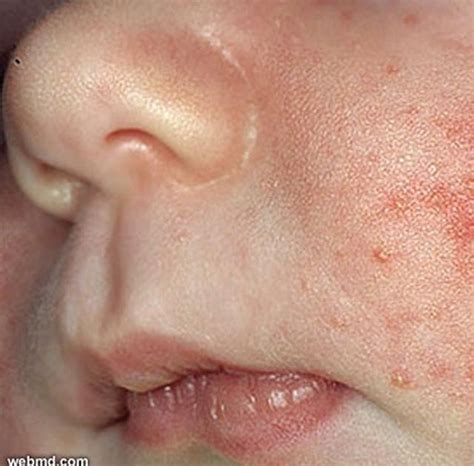 Kulit kering (xerosis) dapat diduga menjadi penyebab rasa gatal. Bintik Merah Pada Kulit Anak 3 Tahun - Berbagai Tahun