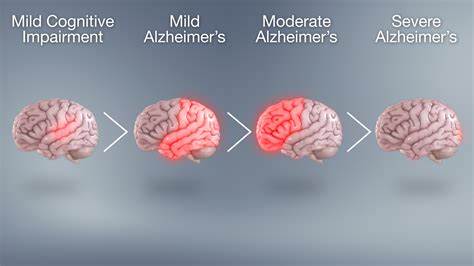 Recently created manufactured peptide can diminish poisonous protein totals in Alzheimer's sickness