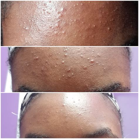Fungal acne can increase in size and how can you get rid of fungal acne? Before&After Recently diagnosing and treating my fungal ...