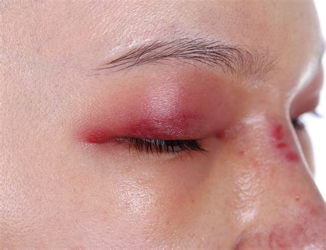 二重整形の腫れが引く期間は？ 何日程度で周りにばれないのか ...