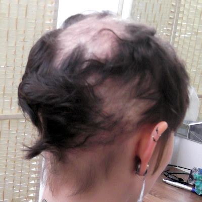 In rare cases, the ingestion of hair after pulling may severely obstruct the bowel and could be fatal. Trichotillomania permanent damage gallery - Lucinda Ellery ...